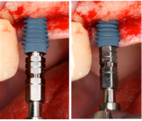  Urethane: El Material de Alta Resistencia Para Implantes Dentales Innovadores!